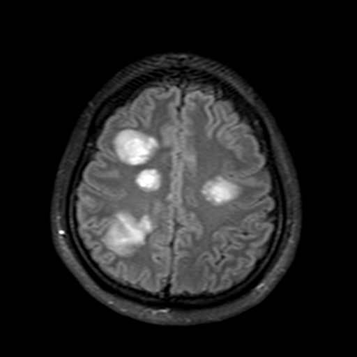 File:Acute disseminated encephalomyelitis (ADEM)- Anti-NMDA receptor encephalitis (Radiopaedia 54920-61198 Axial FLAIR post-GAD 18).png