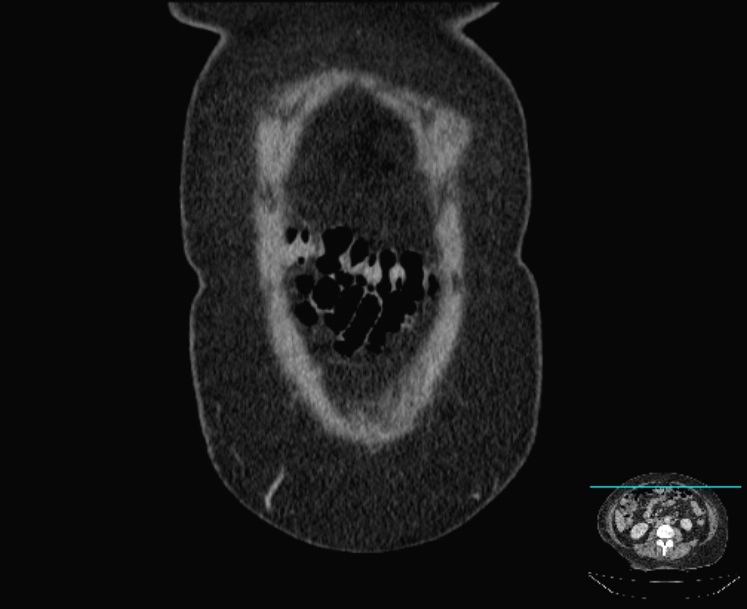 Acute diverticulitis (Radiopaedia 28066-28325 Coronal C+ portal venous phase 10).jpg