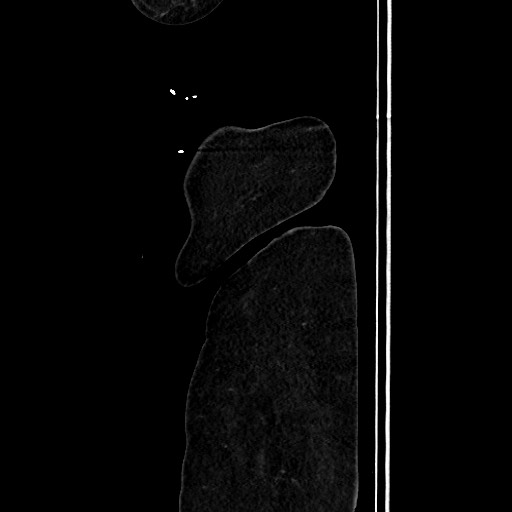 Acute diverticulitis - transverse colon (Radiopaedia 87063-103327 Sagittal C+ portal venous phase 218).jpg