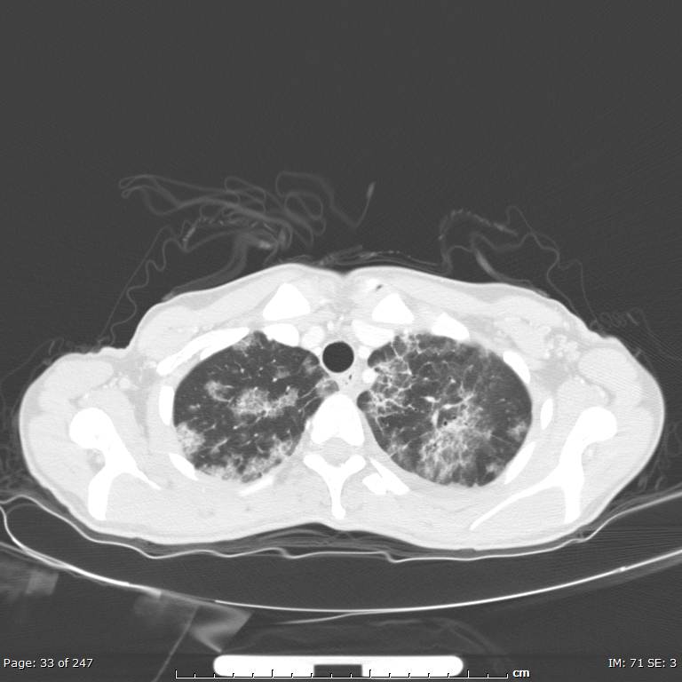 Acute eosinophilic pneumonia (Radiopaedia 48211-53073 Axial lung window 12).jpg