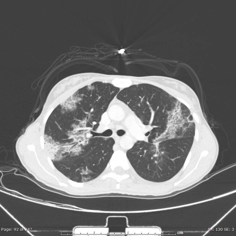 Acute eosinophilic pneumonia (Radiopaedia 48211-53073 Axial lung window 33).jpg