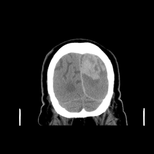 Acute hemorrhagic stroke (Radiopaedia 17507-17223 Coronal non-contrast 51).jpg