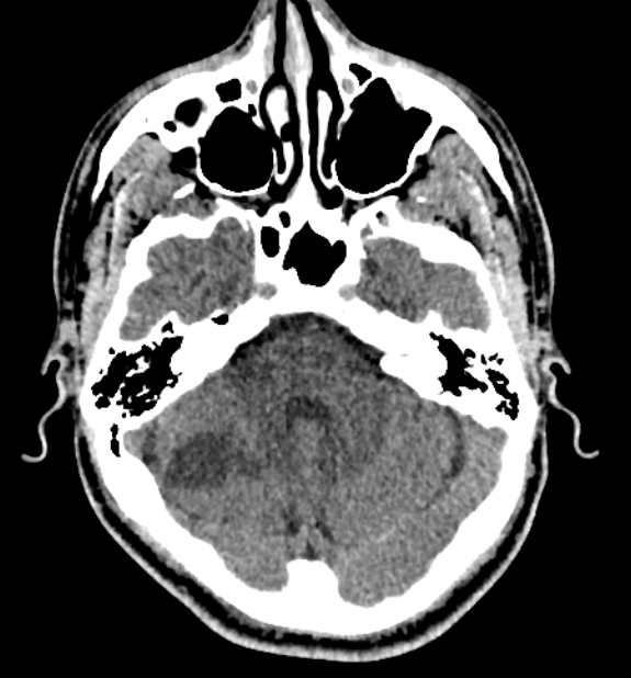 Acute ischemic stroke - posterior circulation territory (Radiopaedia 77670-89881 non-contrast 22).jpg