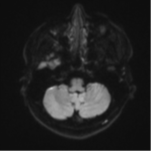Acute left middle cerebral artery territory infarct with clot retrieval (Radiopaedia 47732-52433 Axial DWI 36).png