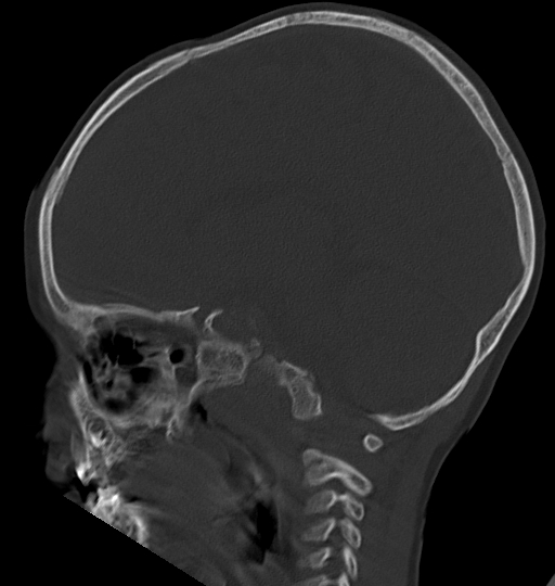 Acute mastoiditis (Radiopaedia 82678-96881 Sagittal bone window 37).jpg
