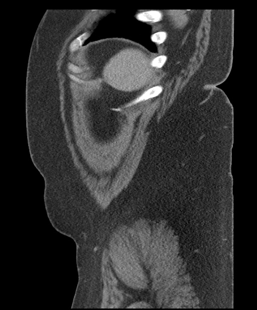 Acute mesenteric venous ischemia (Radiopaedia 46041-50383 Sagittal C+ portal venous phase 109).jpg