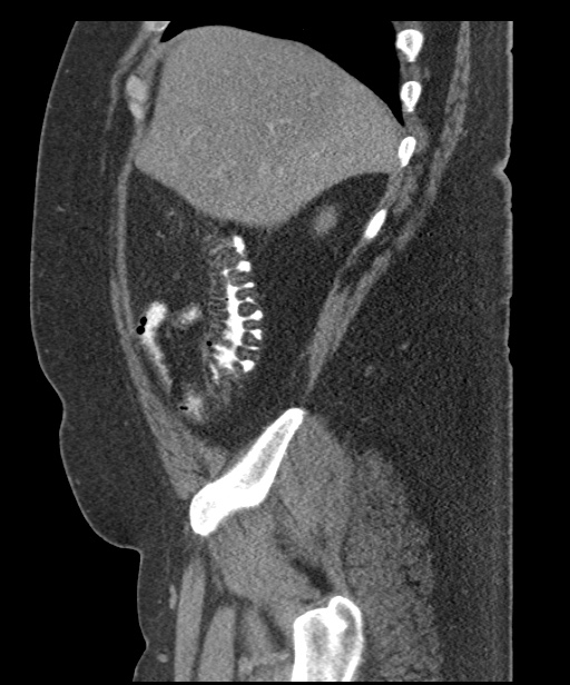 Acute mesenteric venous ischemia (Radiopaedia 46041-50383 Sagittal C+ portal venous phase 21).jpg