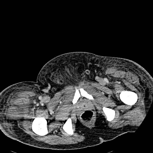 Acute pancreatic necrosis (Radiopaedia 13560-18501 Axial C+ portal venous phase 154).jpg