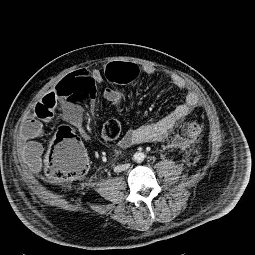 Acute pancreatic necrosis (Radiopaedia 13560-18501 Axial C+ portal venous phase 89).jpg