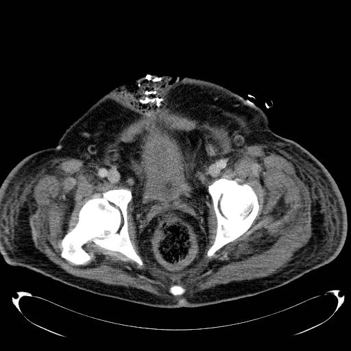 Acute pancreatic necrosis (Radiopaedia 13560-18503 Axial C+ portal venous phase 78).jpg