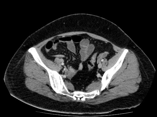 Acute pancreatitis (Radiopaedia 69236-79012 Axial C+ portal venous phase 75).jpg