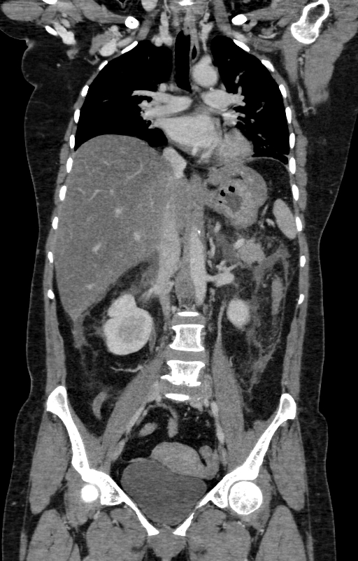 Acute pancreatitis (Radiopaedia 80007-93285 Coronal C+ portal venous phase 66).jpg