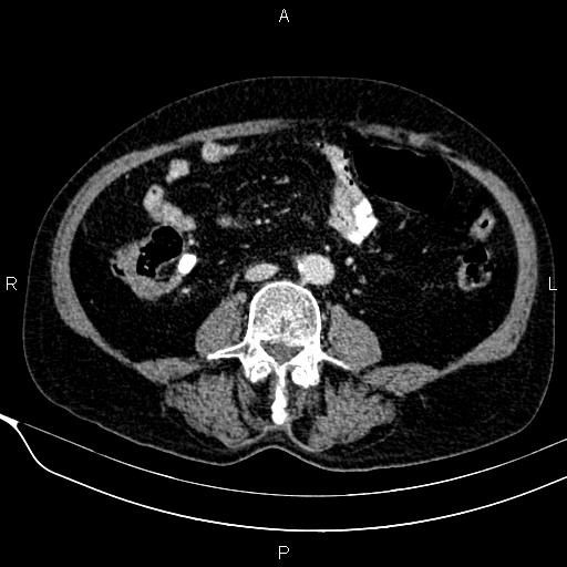 File:Acute pancreatitis (Radiopaedia 85146-100701 Axial C+ portal venous phase 40).jpg