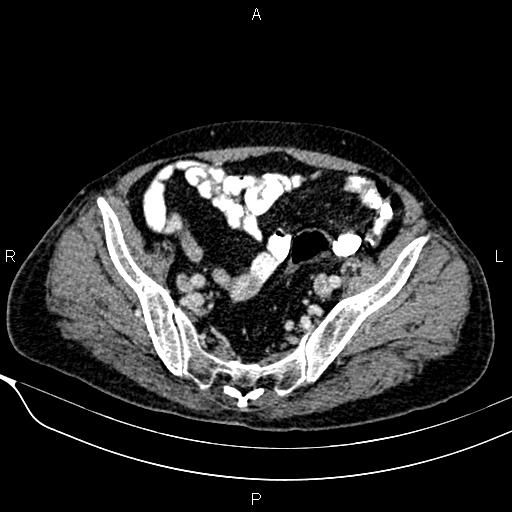 Acute pancreatitis (Radiopaedia 85146-100701 Axial C+ portal venous phase 53).jpg