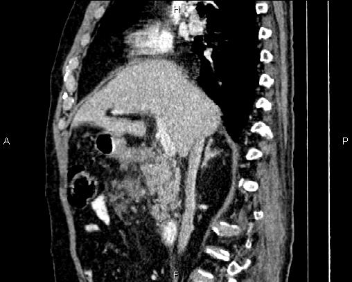 Acute pancreatitis (Radiopaedia 85146-100701 Sagittal C+ portal venous phase 36).jpg