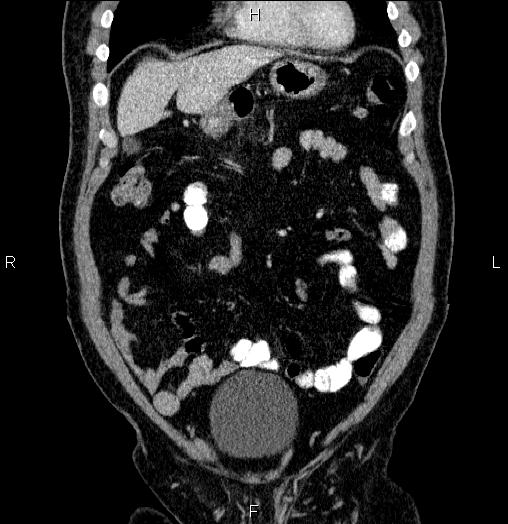 Acute pancreatitis (Radiopaedia 85390-101010 Coronal C+ portal venous phase 16).jpg