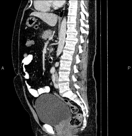 Acute pancreatitis (Radiopaedia 85390-101010 Sagittal C+ portal venous phase 52).jpg