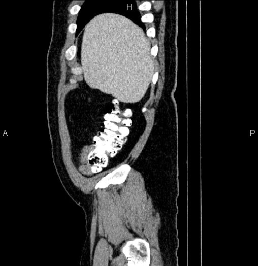 Acute pancreatitis (Radiopaedia 85390-101010 Sagittal C+ portal venous phase 8).jpg