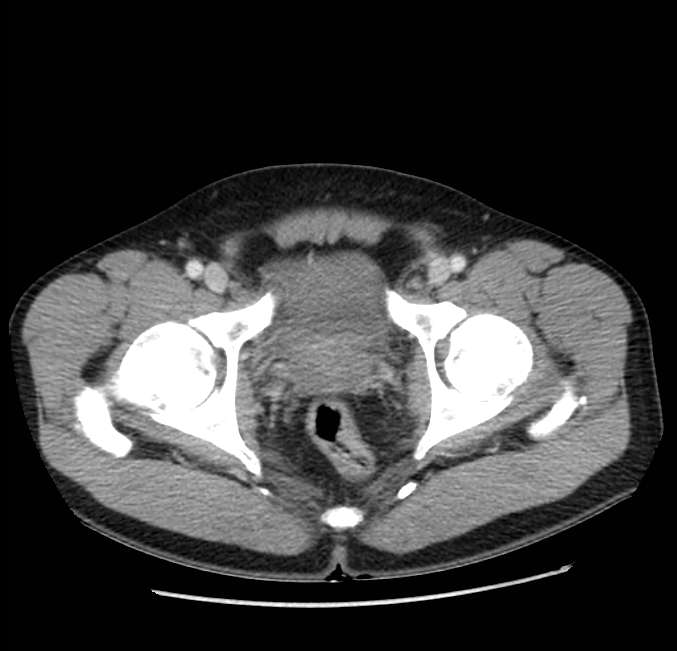 Acute pancreatitis - Balthazar E (Radiopaedia 23080-23110 Axial C+ portal venous phase 70).jpg