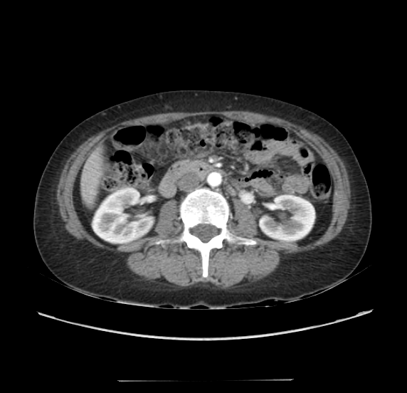 File:Acute pancreatitis - Balthazar E - post ERCP (Radiopaedia 27562-27772 Axial C+ arterial phase 29).png