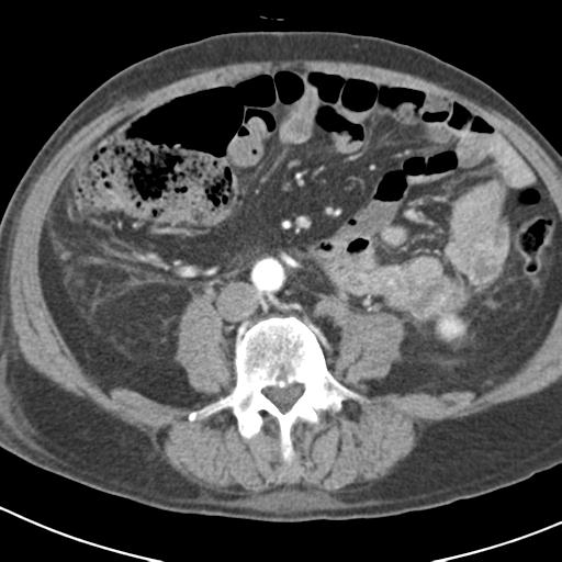 File:Acute pancreatitis and walled-off necrosis (Radiopaedia 29888-30403 Axial C+ portal venous phase 35).jpg