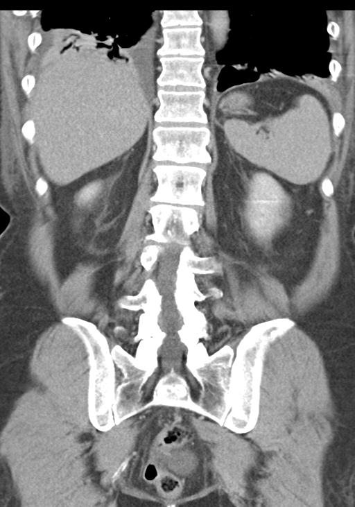 Acute pancreatitis and walled-off necrosis (Radiopaedia 29888-30403 E 43).jpg