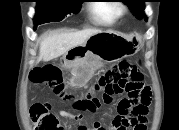 File:Acute pancreatitis and walled-off necrosis (Radiopaedia 29888-30404 Coronal C+ portal venous phase 13).jpg