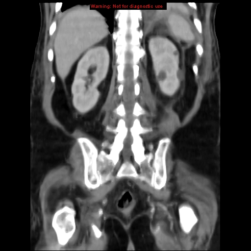Acute pancreatitis with incidental pancreatic lipoma (Radiopaedia 10190-10730 Coronal C+ portal venous phase 56).jpg