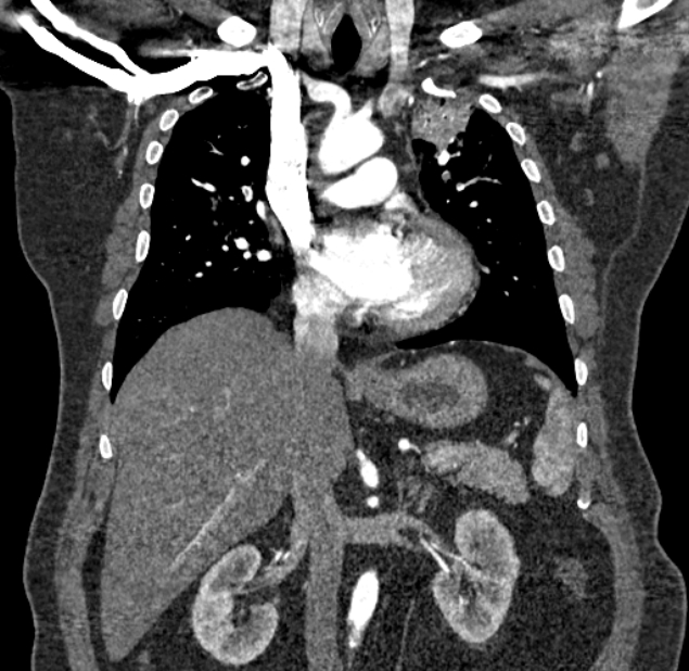 Acute pulmonary embolism with pulmonary infarcts (Radiopaedia 77688-89908 Coronal C+ CTPA 41).jpg