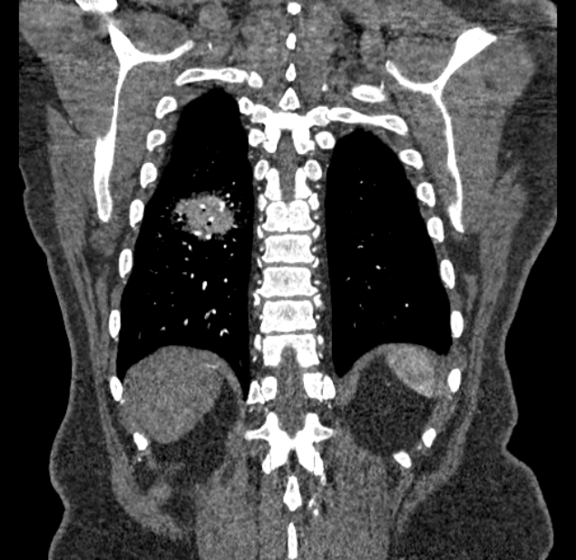 Acute pulmonary embolism with pulmonary infarcts (Radiopaedia 77688-89908 Coronal C+ CTPA 88).jpg
