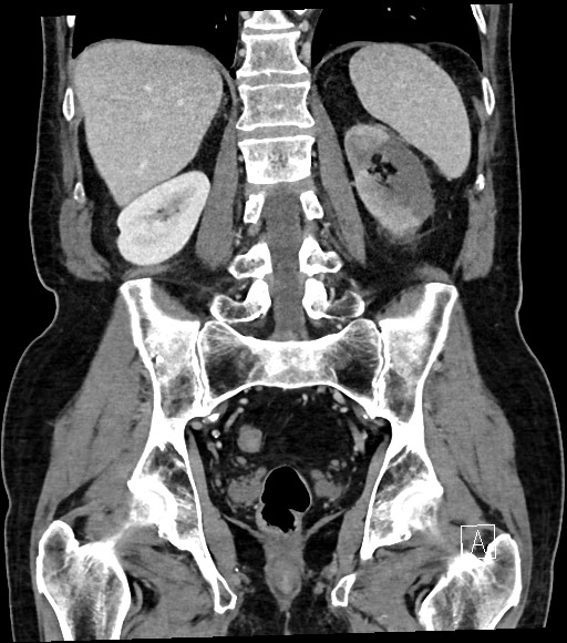 Acute renal infarction (Radiopaedia 59375-66736 Coronal C+ portal venous phase 44).jpg