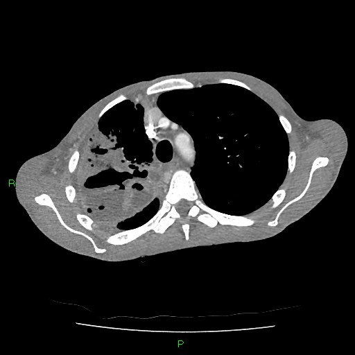 File:Acute right lung abscess (Radiopaedia 34806-36258 Axial C+ arterial phase 48).jpg