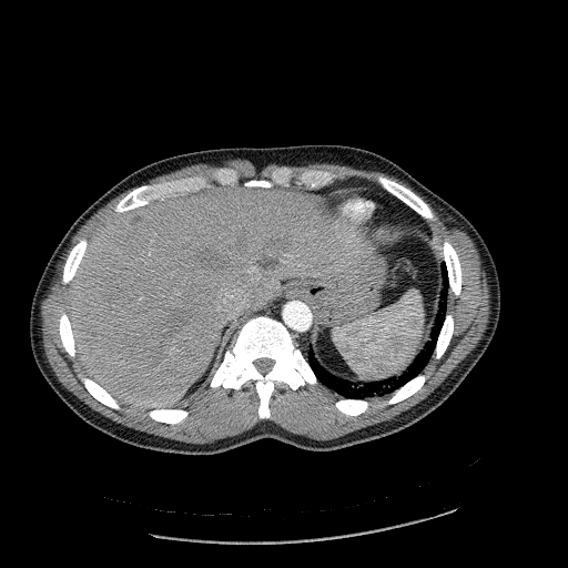 Acute segmental pulmonary emboli and pulmonary infarction (Radiopaedia 62264-70444 Axial C+ CTPA 100).jpg