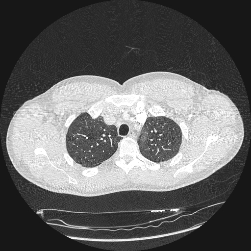 Acute segmental pulmonary emboli and pulmonary infarction (Radiopaedia 62264-70444 Axial lung window 35).jpg