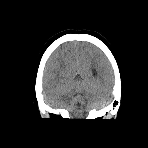 Acute subarachnoid hemorrhage and accessory anterior cerebral artery (Radiopaedia 69231-79008 Coronal non-contrast 53).jpg