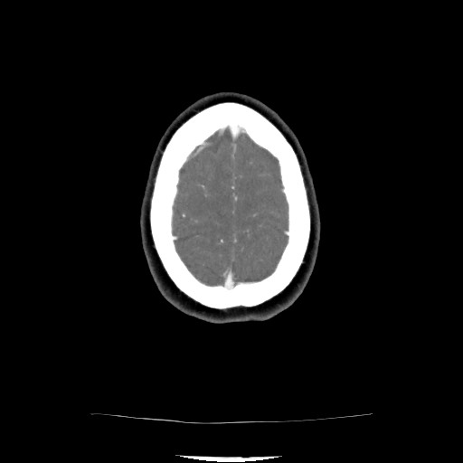 Acute subarachnoid hemorrhage and accessory anterior cerebral artery (Radiopaedia 69231-79009 Axial C+ arterial phase 119).jpg