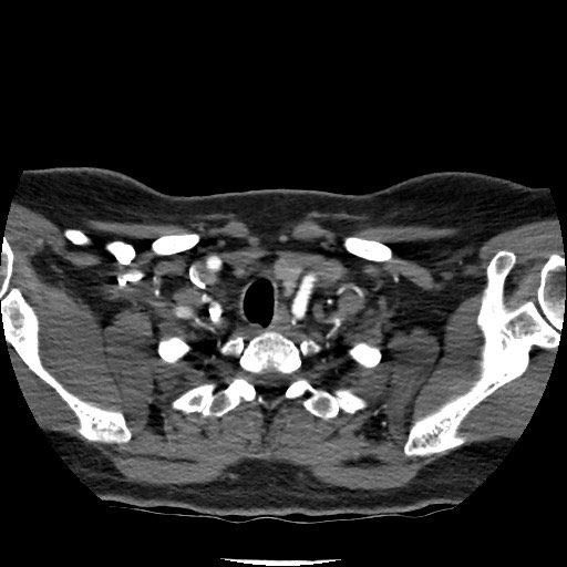 Acute subarachnoid hemorrhage and accessory anterior cerebral artery (Radiopaedia 69231-79009 Axial C+ arterial phase 28).jpg