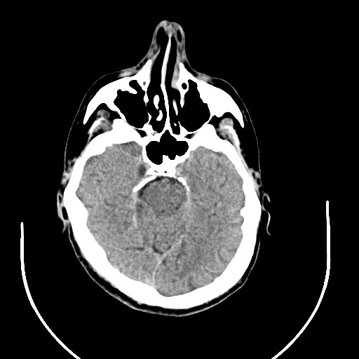 Acute superior cerebellar artery territory infarct (Radiopaedia 84104-99359 Coronal non-contrast 1).jpg
