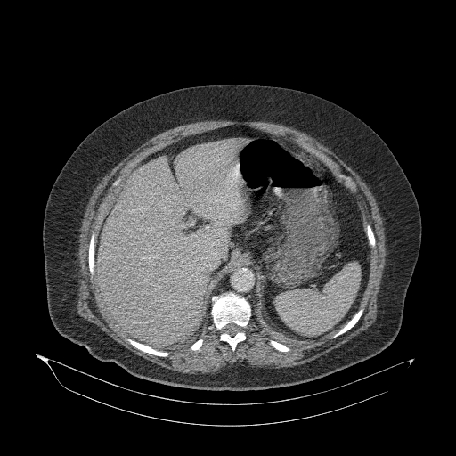 File:Acute superior mesenteric artery occlusion (Radiopaedia 51288-56960 Axial C+ portal venous phase 25).jpg