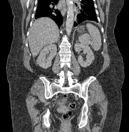 Acute superior mesenteric artery occlusion (Radiopaedia 51288-56960 Coronal C+ portal venous phase 53).jpg