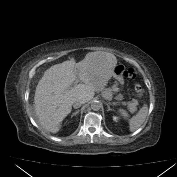 Acute tubular necrosis (Radiopaedia 28077-28334 Axial non-contrast 20).jpg