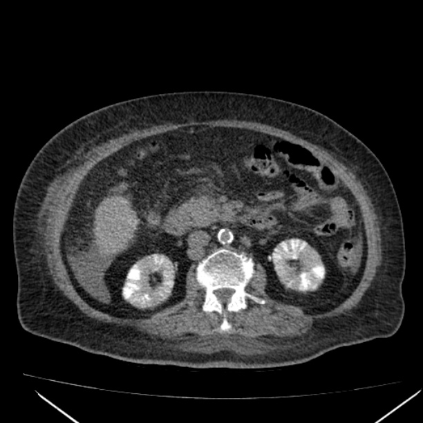 Acute tubular necrosis (Radiopaedia 28077-28334 Axial non-contrast 33).jpg
