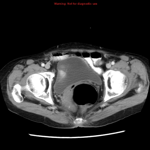 Adenocarcinoma of the colon (Radiopaedia 8191-9039 Axial liver window 70).jpg