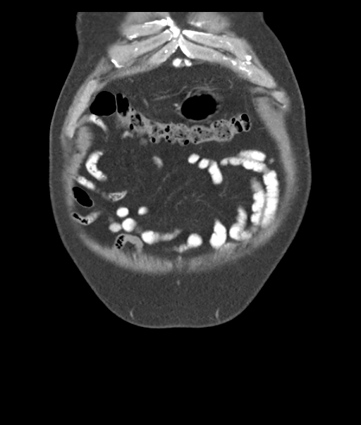 Adenocarcioma of rectum- T1 lesion (Radiopaedia 36921-38547 Coronal C+ portal venous phase 9).png