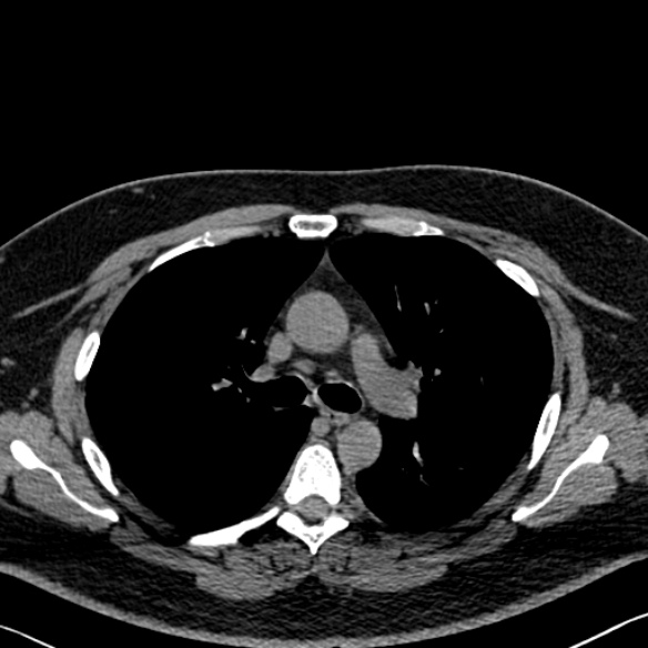 Adenoid cystic carcinoma of the trachea (Radiopaedia 49042-54137 Axial non-contrast 132).jpg