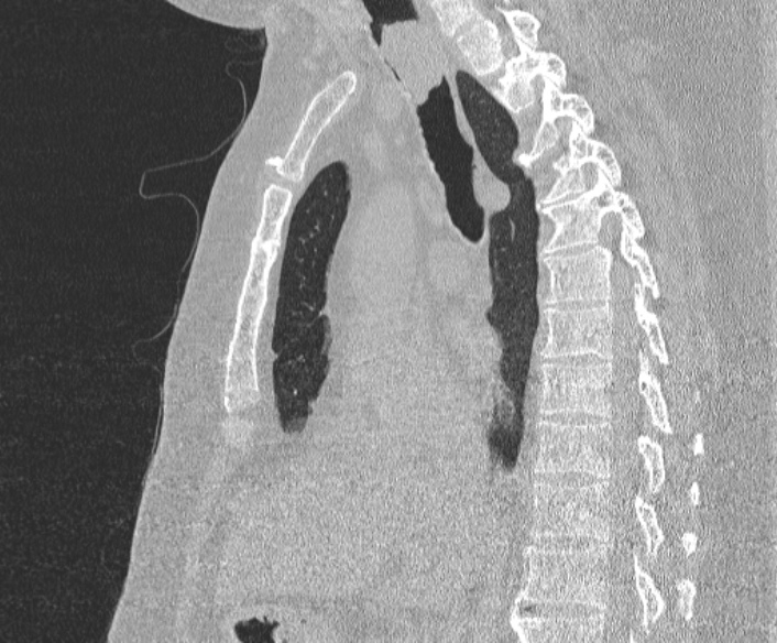 Adenoid cystic carcinoma of the trachea (Radiopaedia 49042-54137 Sagittal lung window 224).jpg