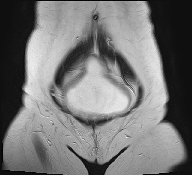 File:Adenomyosis - ovarian endometriomas (Radiopaedia 67031-76350 Coronal T2 2).jpg