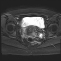 File:Adenomyosis and endometriotic cysts (Radiopaedia 82300-96367 Axial DWI 6).jpg