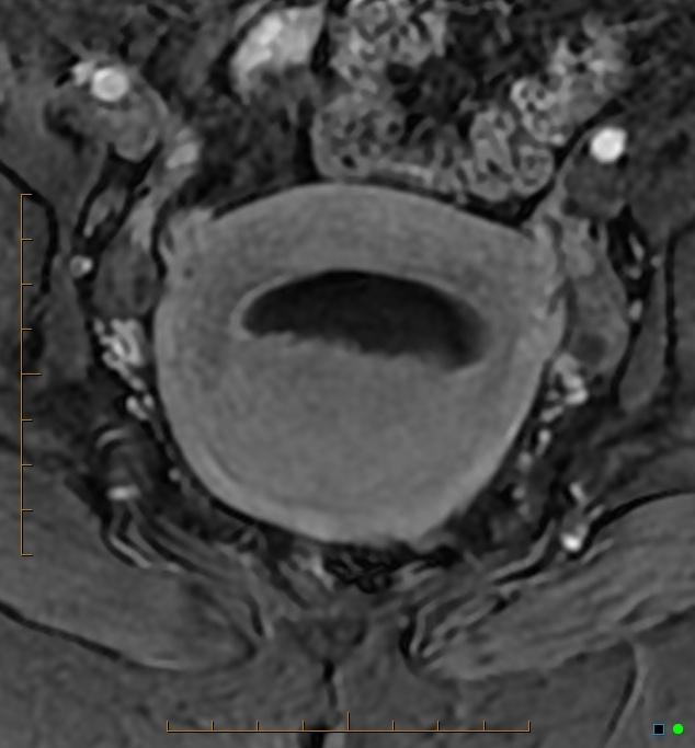 Adenomyosis uterus with hematometra (Radiopaedia 45779-50011 Axial T1 C+ fat sat 32).jpg