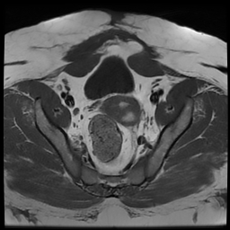 File:Adenomyosis within a didelphys uterus (Radiopaedia 70175-80215 Axial T1 25).jpg